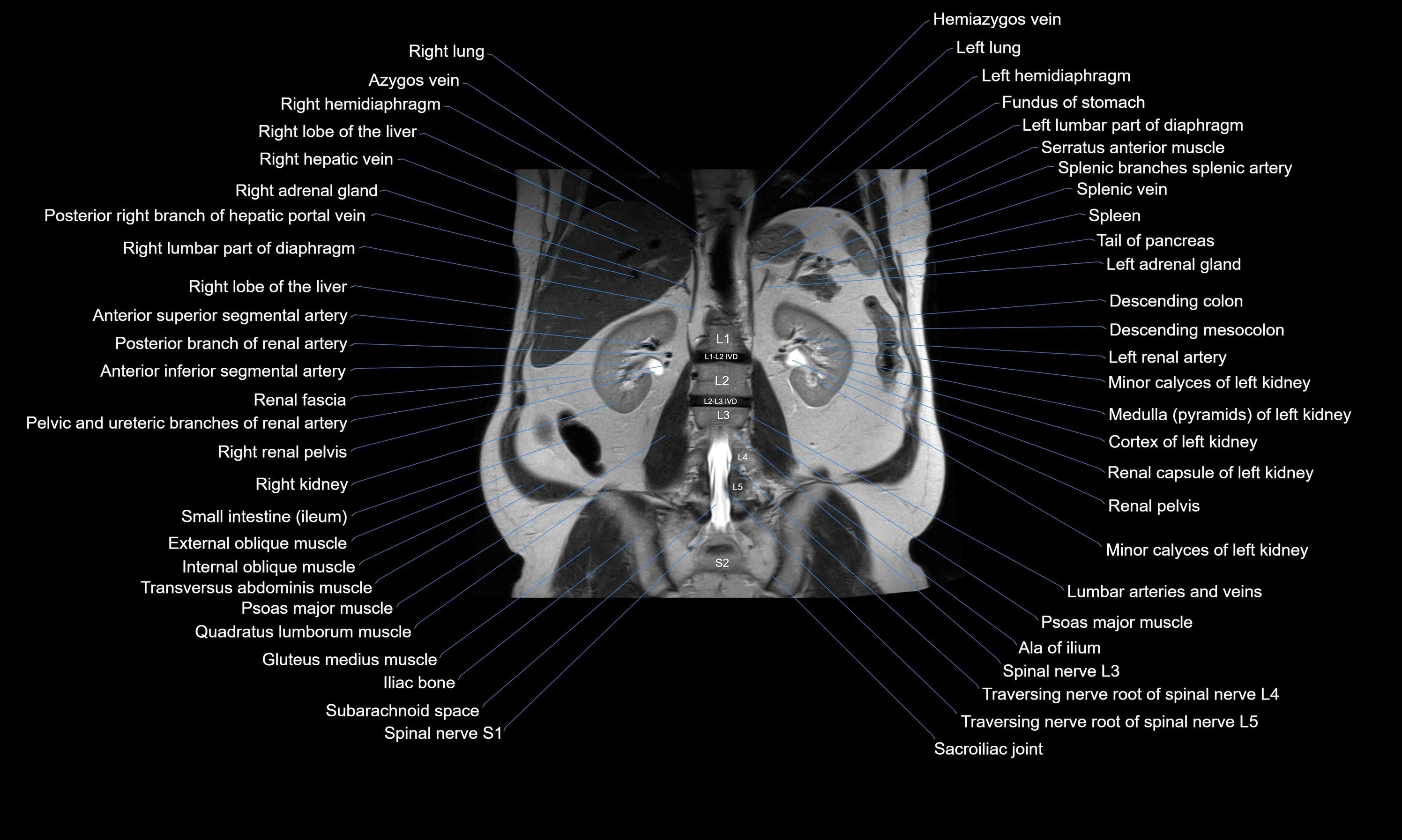 MRI Abdomen axial cross sectional anatomy radiology  image-img-00001-00039.webp